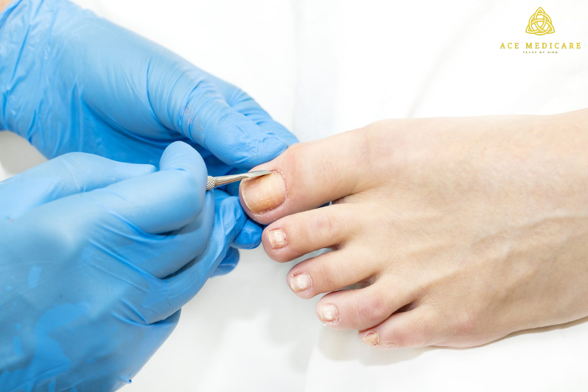 Understanding Nail Surgery: Procedures and Recovery